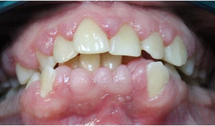 Evaluación al mes de realizar educación en higiene oral, controles de placa
y raspaje y alisado radicular